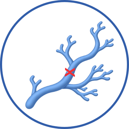Blood flow stops